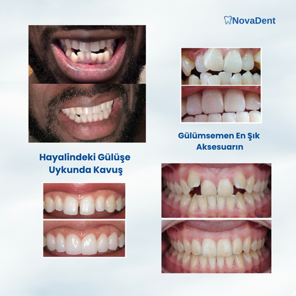NovaDent™Diş-Çene Hizalama Plağı